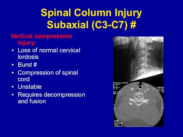 Spinal Column Injury Subaxial (C3-C7) # Vertical compression injury: Loss of normal