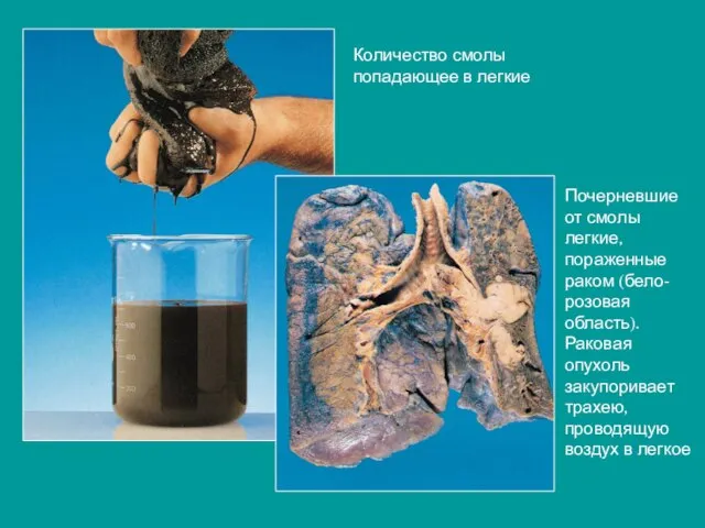 Количество смолы попадающее в легкие Почерневшие от смолы легкие, пораженные раком (бело-розовая