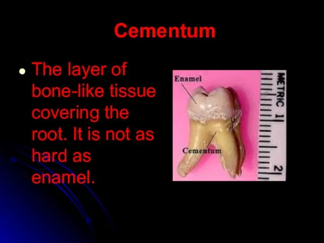 Cementum The layer of bone-like tissue covering the root. It is not as hard as enamel.