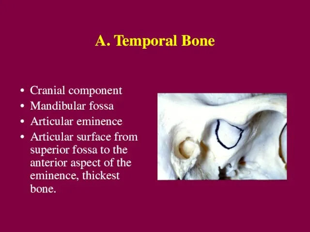 A. Temporal Bone Cranial component Mandibular fossa Articular eminence Articular surface from