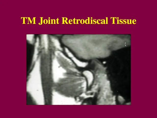 TM Joint Retrodiscal Tissue