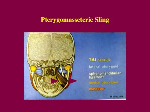 Pterygomasseteric Sling