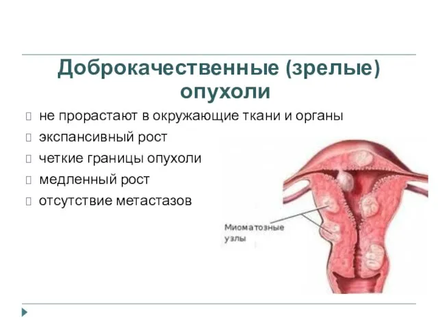 Доброкачественные (зрелые) опухоли не прорастают в окружающие ткани и органы экспансивный рост