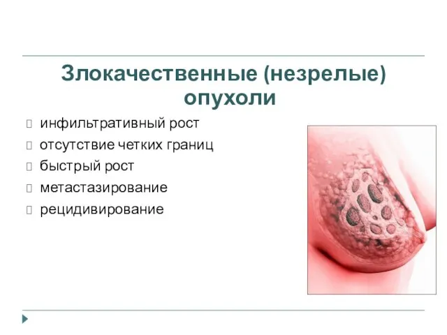 Злокачественные (незрелые) опухоли инфильтративный рост отсутствие четких границ быстрый рост метастазирование рецидивирование