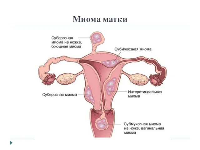 Миома матки