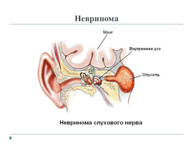 Невринома