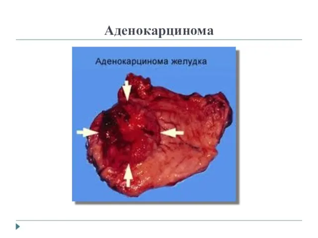 Аденокарцинома