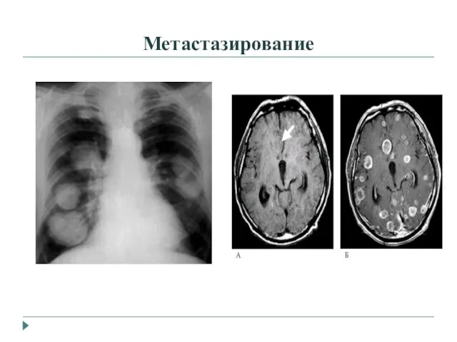 Метастазирование