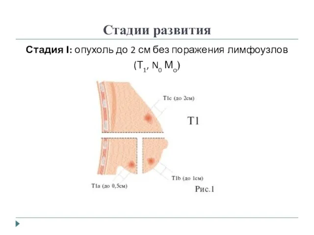 Стадии развития Стадия I: опухоль до 2 см без поражения лимфоузлов (Т1, N0 Мо)