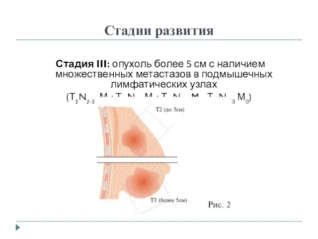 Стадии развития Стадия III: опухоль более 5 см с наличием множественных метастазов