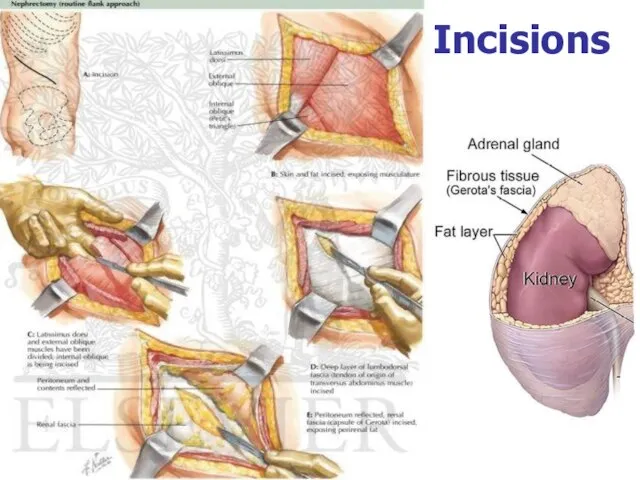 Incisions