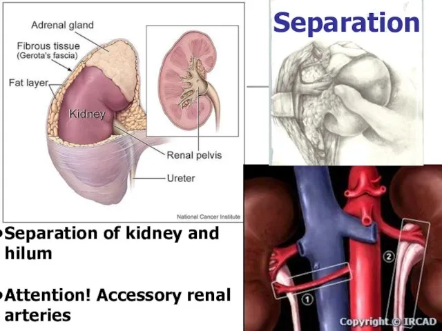 Separation of kidney and hilum Attention! Accessory renal arteries Separation