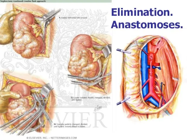 Elimination. Anastomoses.