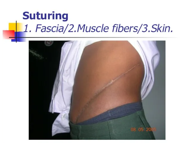 Suturing 1. Fascia/2.Muscle fibers/3.Skin.