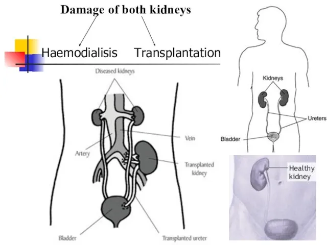 Damage of both kidneys Haemodialisis Transplantation