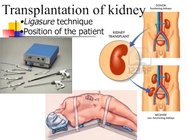 Transplantation of kidney Ligasure technique Position of the patient