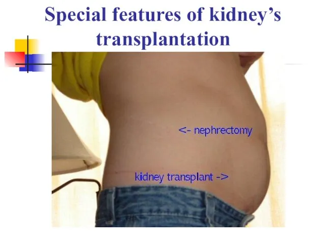 Special features of kidney’s transplantation