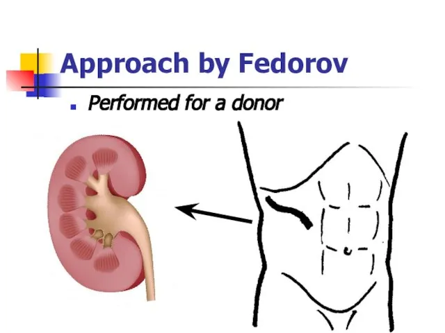 Approach by Fedorov Performed for a donor