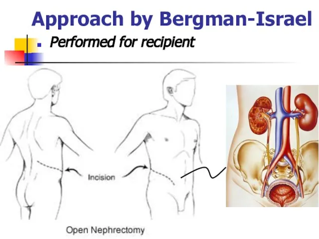 Approach by Bergman-Israel Performed for recipient