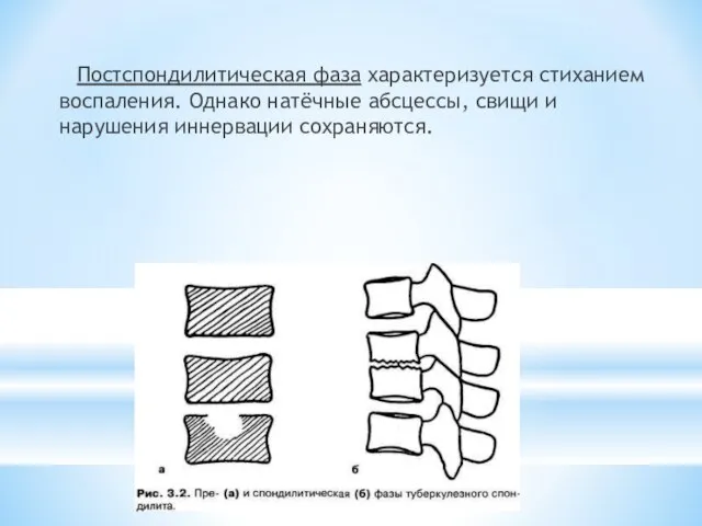 Постспондилитическая фаза характеризуется стиханием воспаления. Однако натёчные абсцессы, свищи и нарушения иннервации сохраняются.