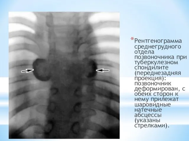 Рентгенограмма среднегрудного отдела позвоночника при туберкулезном спондилите (переднезадняя проекция): позвоночник деформирован, с