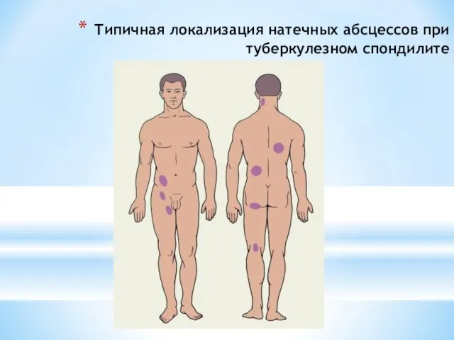 Типичная локализация натечных абсцессов при туберкулезном спондилите