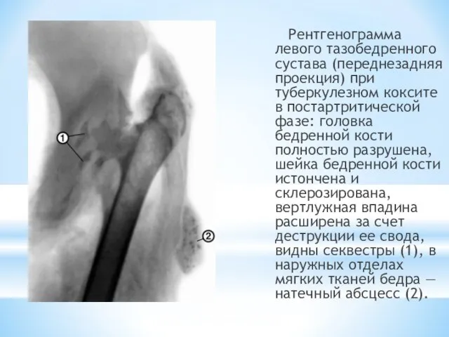 Рентгенограмма левого тазобедренного сустава (переднезадняя проекция) при туберкулезном коксите в постартритической фазе: