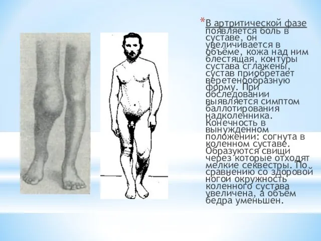 В артритической фазе появляется боль в суставе, он увеличивается в объёме, кожа