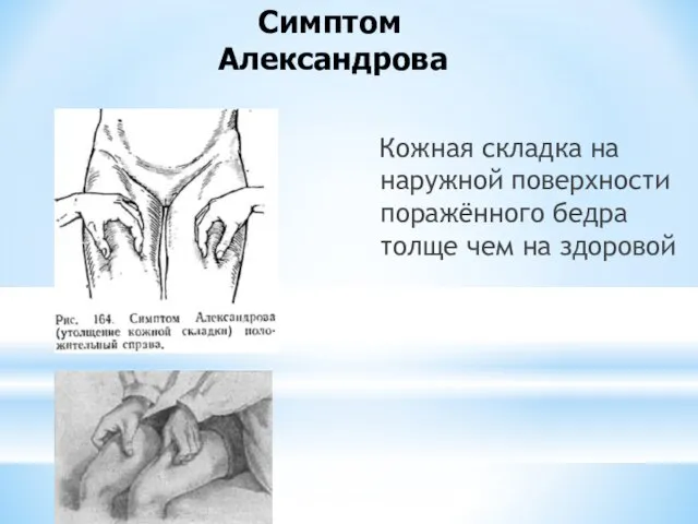 Кожная складка на наружной поверхности поражённого бедра толще чем на здоровой Симптом Александрова