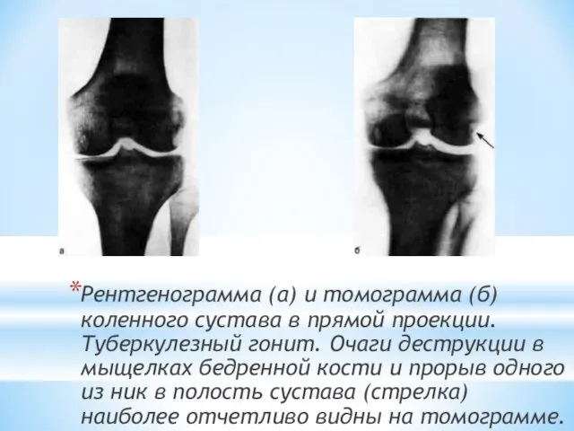 Рентгенограмма (а) и томограмма (б) коленного сустава в прямой проекции. Туберкулезный гонит.