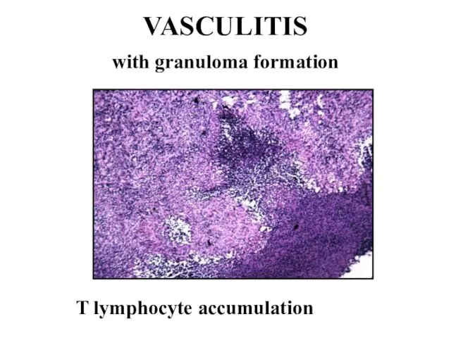 VASCULITIS with granuloma formation T lymphocyte accumulation