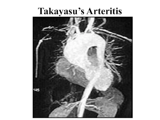 Takayasu’s Arteritis