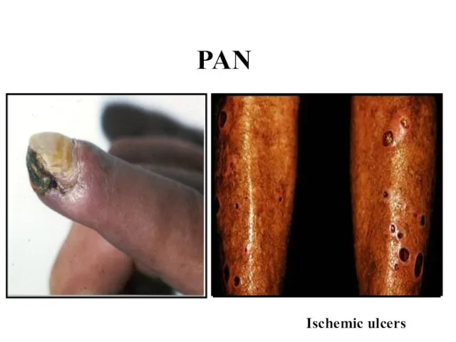 PAN Ischemic ulcers