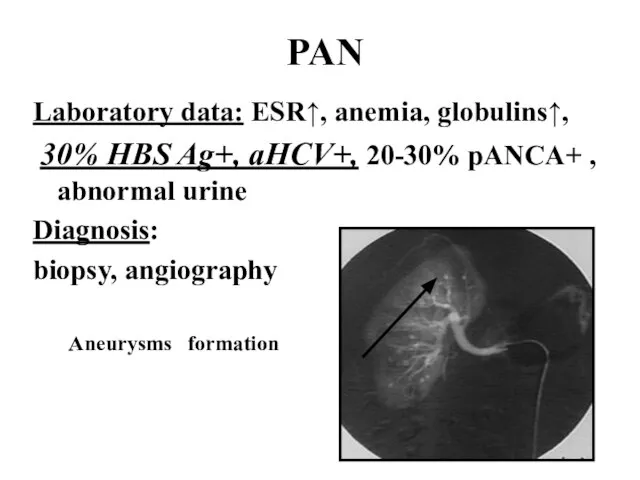 PAN Laboratory data: ESR↑, anemia, globulins↑, 30% HBS Ag+, aHCV+, 20-30% pANCA+