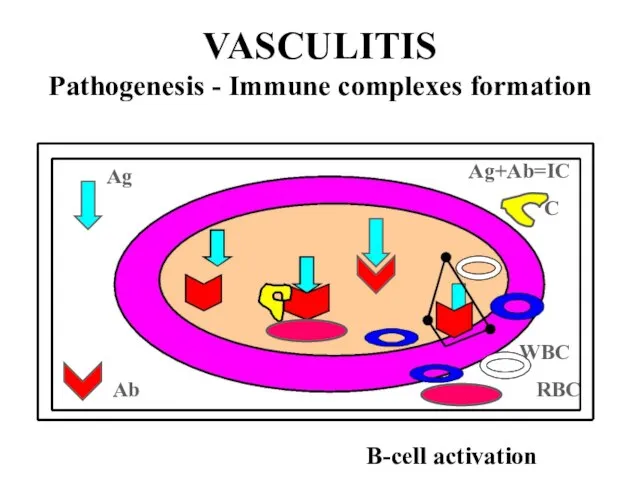 VASCULITIS Pathogenesis - Immune complexes formation Ag Ab WBC Ag+Ab=IC C B-cell activation RBC