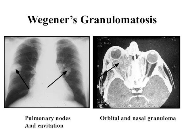 Wegener’s Granulomatosis Orbital and nasal granuloma Pulmonary nodes And cavitation