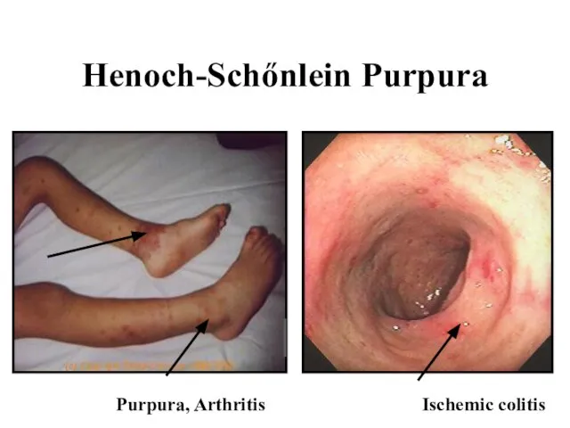 Henoch-Schőnlein Purpura Purpura, Arthritis Ischemic colitis