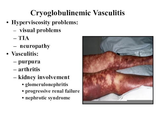 Cryoglobulinemic Vasculitis Hyperviscosity problems: visual problems TIA neuropathy Vasculitis: purpura arthritis kidney