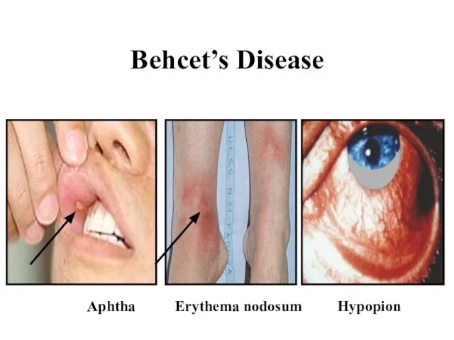 Behcet’s Disease Aphtha Erythema nodosum Hypopion