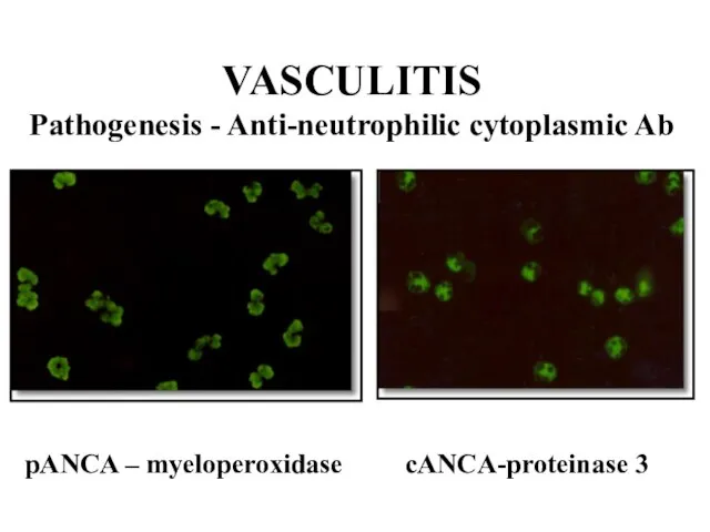 VASCULITIS Pathogenesis - Anti-neutrophilic cytoplasmic Ab pANCA – myeloperoxidase cANCA-proteinase 3