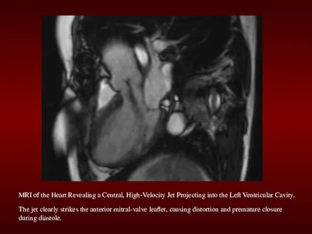 MRI of the Heart Revealing a Central, High-Velocity Jet Projecting into the