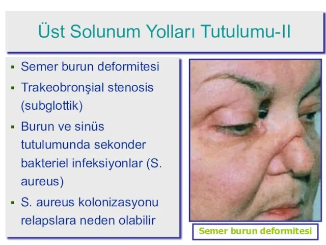 Üst Solunum Yolları Tutulumu-II Semer burun deformitesi Trakeobronşial stenosis (subglottik) Burun ve