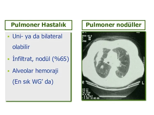 Uni- ya da bilateral olabilir İnfiltrat, nodül (%65) Alveolar hemoraji (En sık