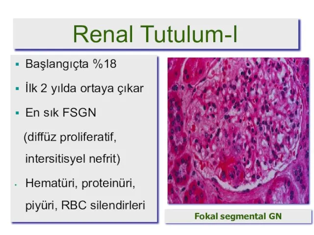 Renal Tutulum-I Başlangıçta %18 İlk 2 yılda ortaya çıkar En sık FSGN