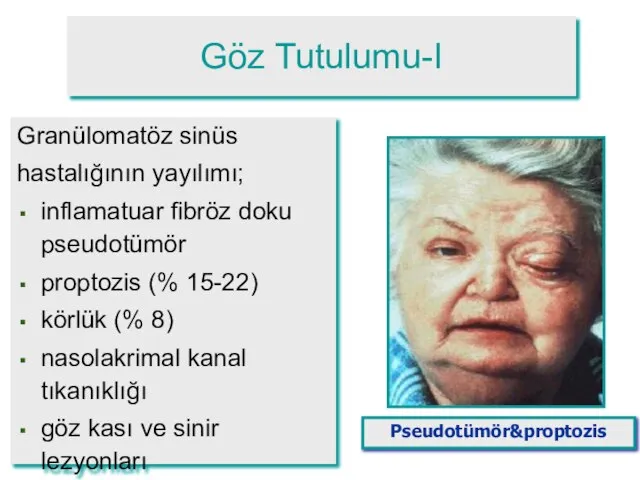 Göz Tutulumu-I Granülomatöz sinüs hastalığının yayılımı; inflamatuar fibröz doku pseudotümör proptozis (%