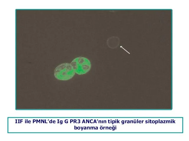 IIF ile PMNL’de Ig G PR3 ANCA’nın tipik granüler sitoplazmik boyanma örneği