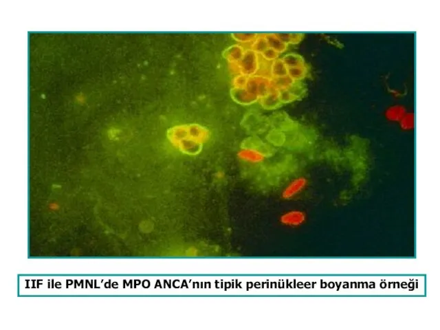 IIF ile PMNL’de MPO ANCA’nın tipik perinükleer boyanma örneği