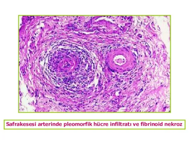 Safrakesesi arterinde pleomorfik hücre infiltratı ve fibrinoid nekroz