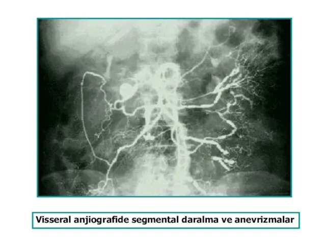 Visseral anjiografide segmental daralma ve anevrizmalar