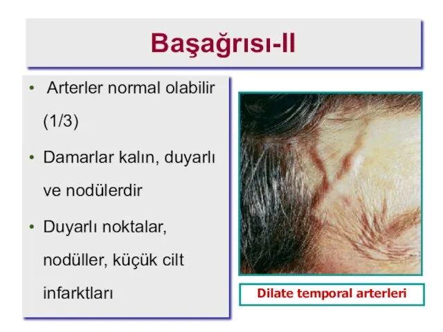 Başağrısı-II Arterler normal olabilir (1/3) Damarlar kalın, duyarlı ve nodülerdir Duyarlı noktalar,